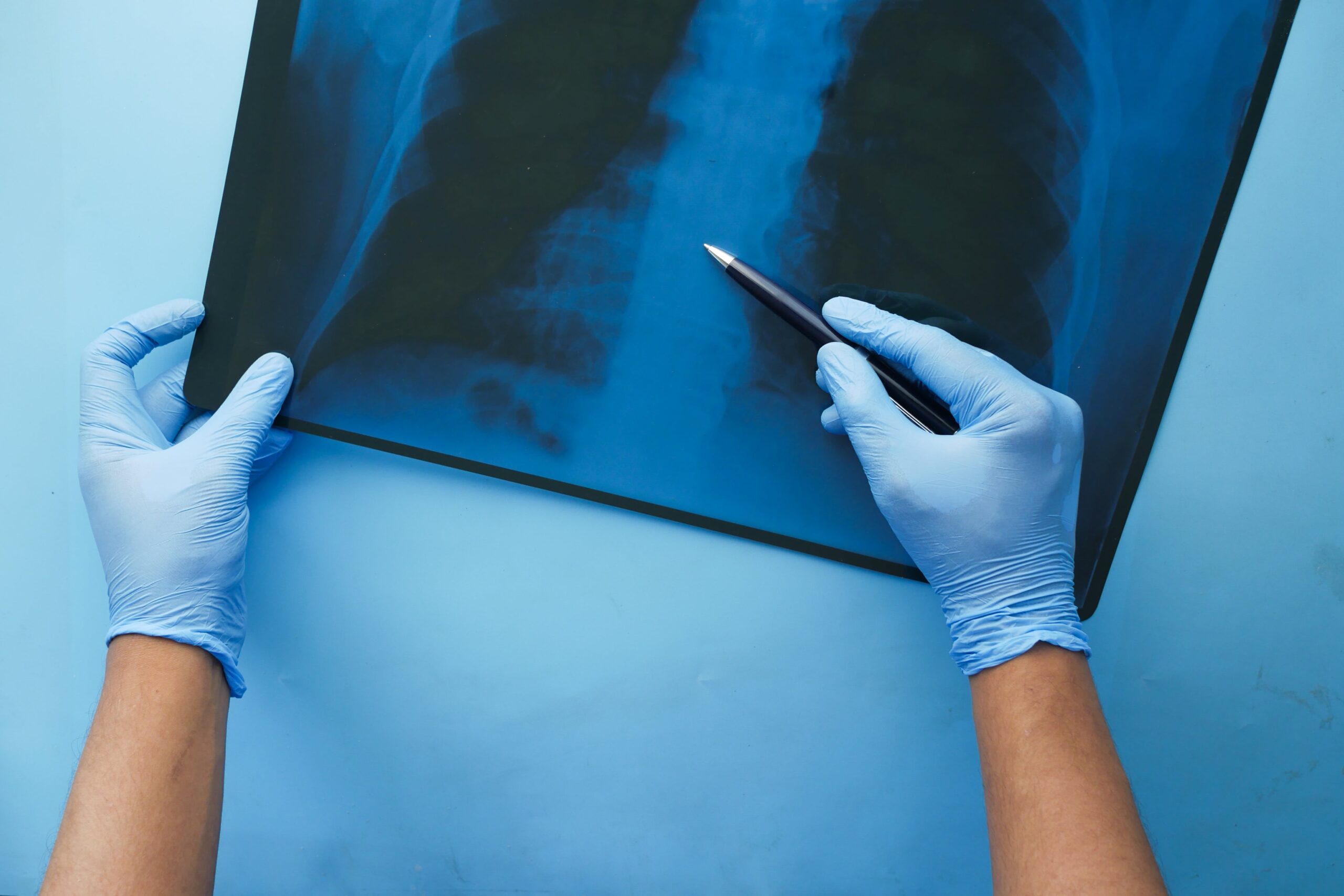 COPD Causes and Treatments: A Guide to Better Respiratory Health